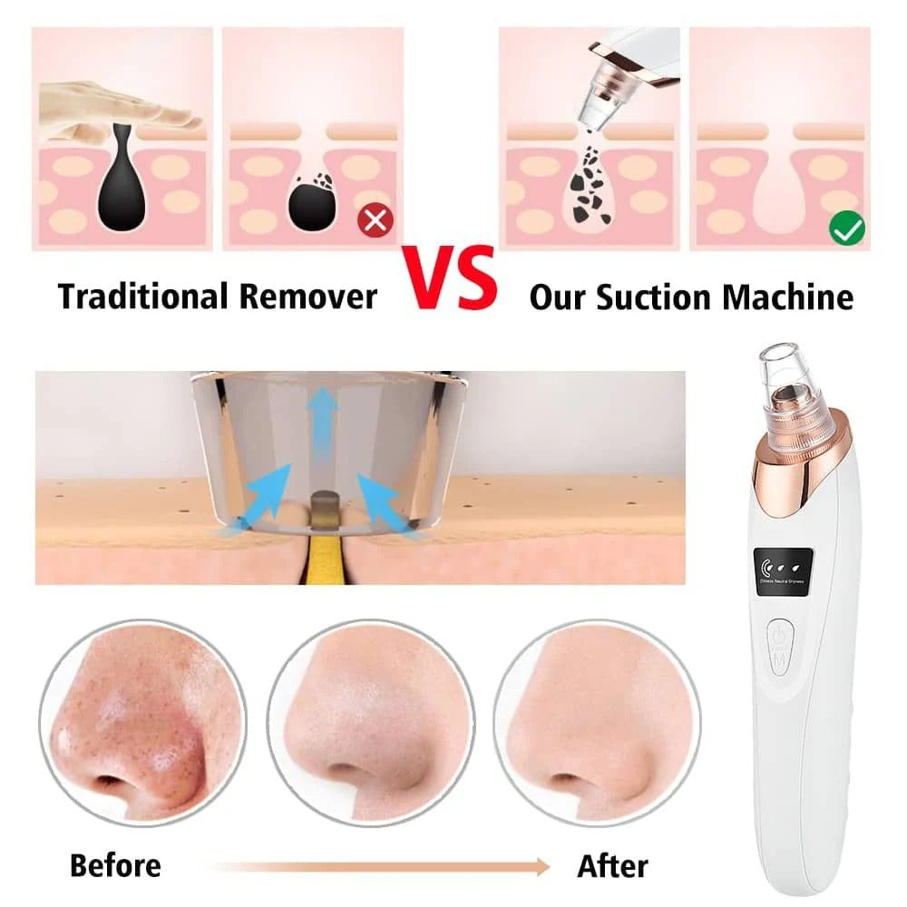Blackhead Remover Vacuum Electric Pore Cleaner Acne Remover Facial Tool